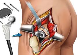 Hip Replacement Surgeon