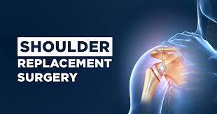 Shoulder Replacement