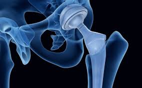 Hip Replacement Surgeon