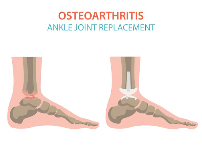 Ankle Replacement