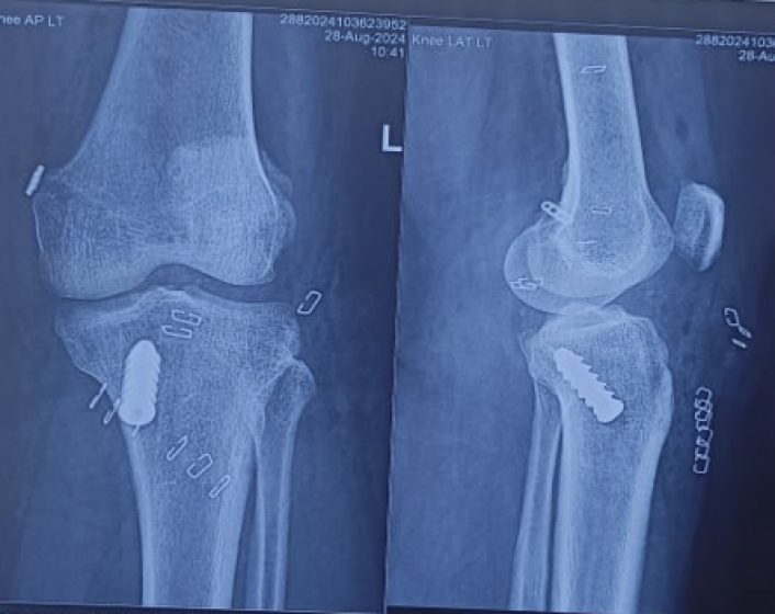 Arthroscopic PCL reconstruction