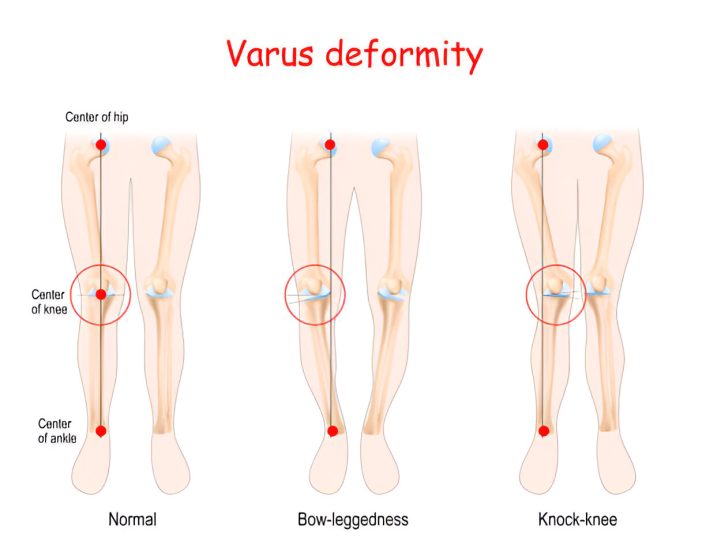 Bone Deformitie