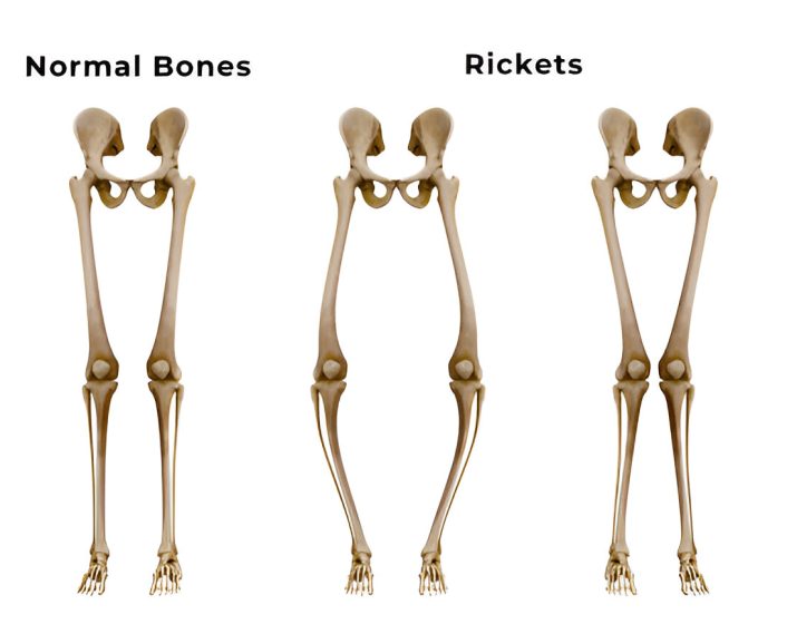 Bone Deformities Treatment