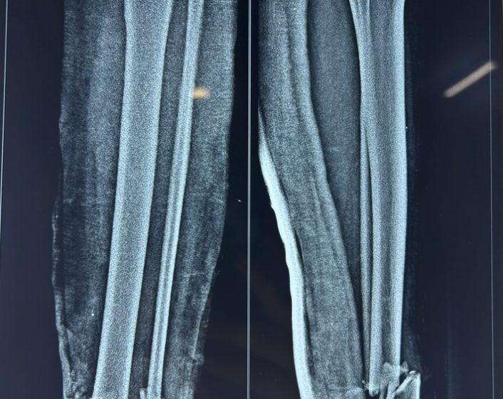 Both bone leg fracture