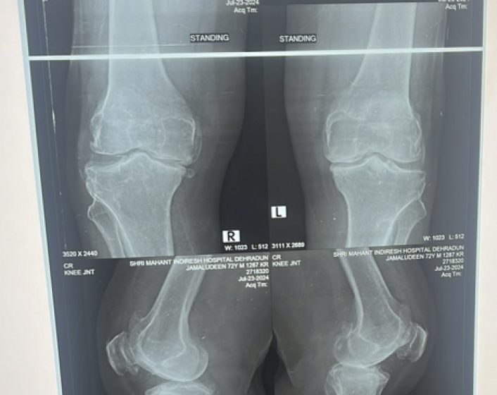 End stage arthritis of knee