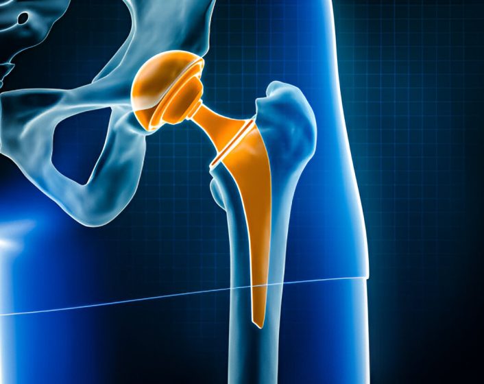 Hip Replacementtreatment