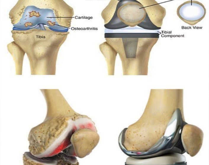 Knee Replacement