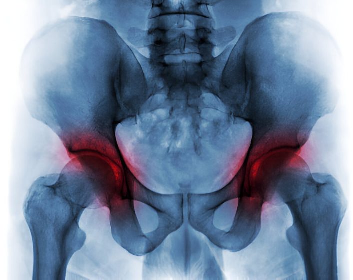 LCL Injury