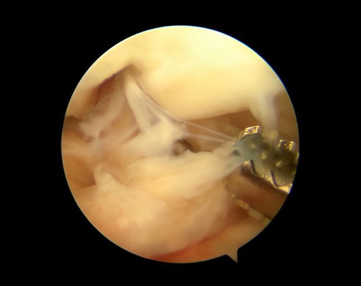 PCL Injury