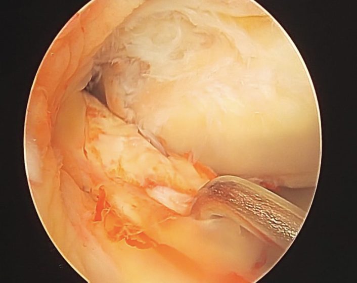PCL tear