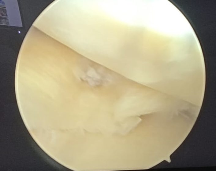 Repaired medial meniscus