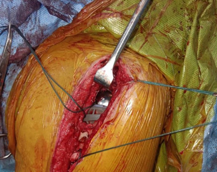 Reverse shoulder replacement