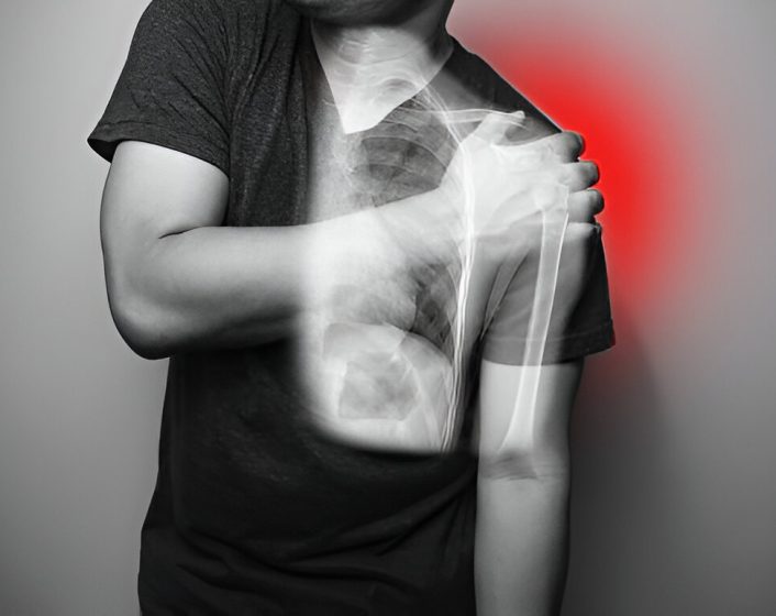 Shoulder Dislocatio