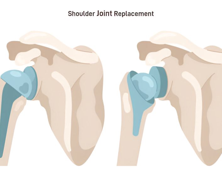 Shoulder Replacemen