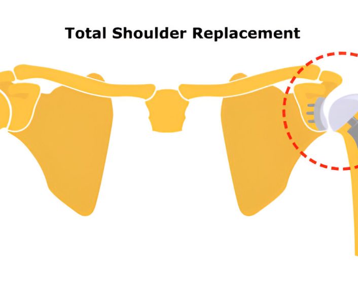 Shoulder Replacement