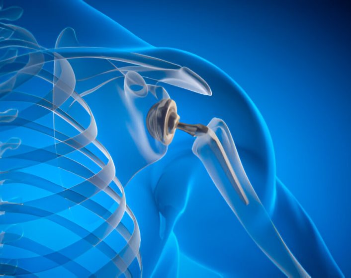 Shoulder Replacement