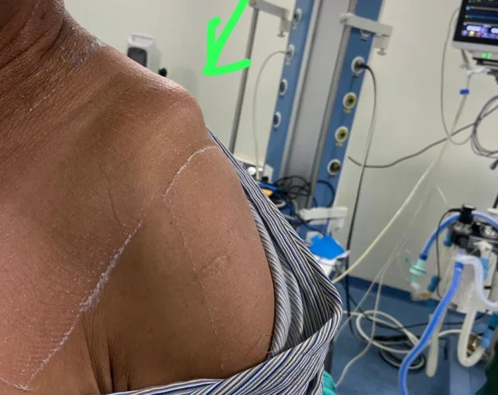 ShoulderDislocation1