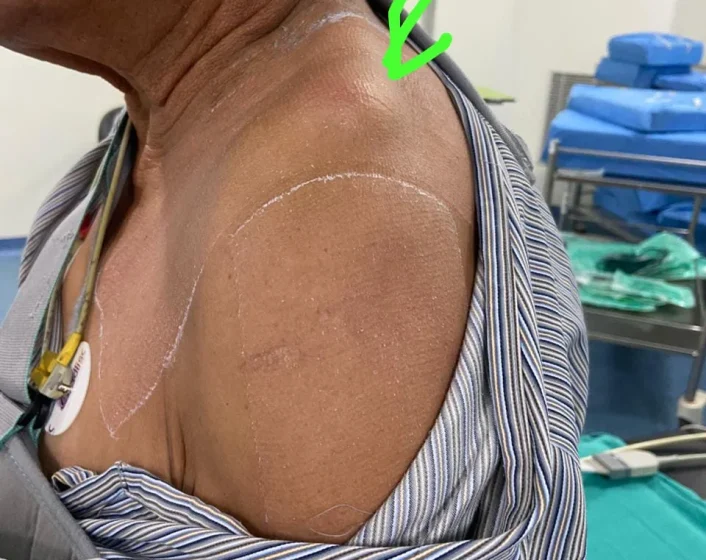 ShoulderDislocation2