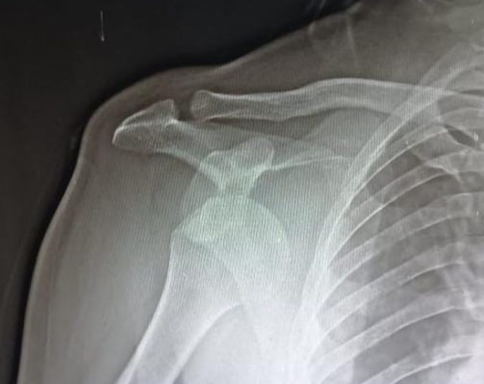 shoulder dislocation